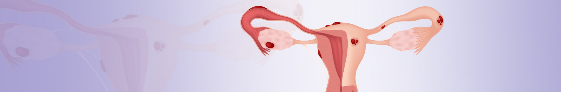 Endometriose: conheça os tipos da doença
