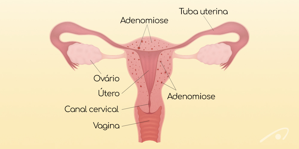 Adenomiose: conheça os sintomas