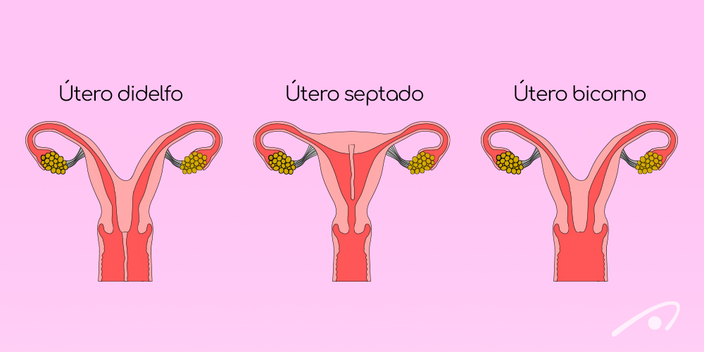 Malformações uterinas: como ocorrem?