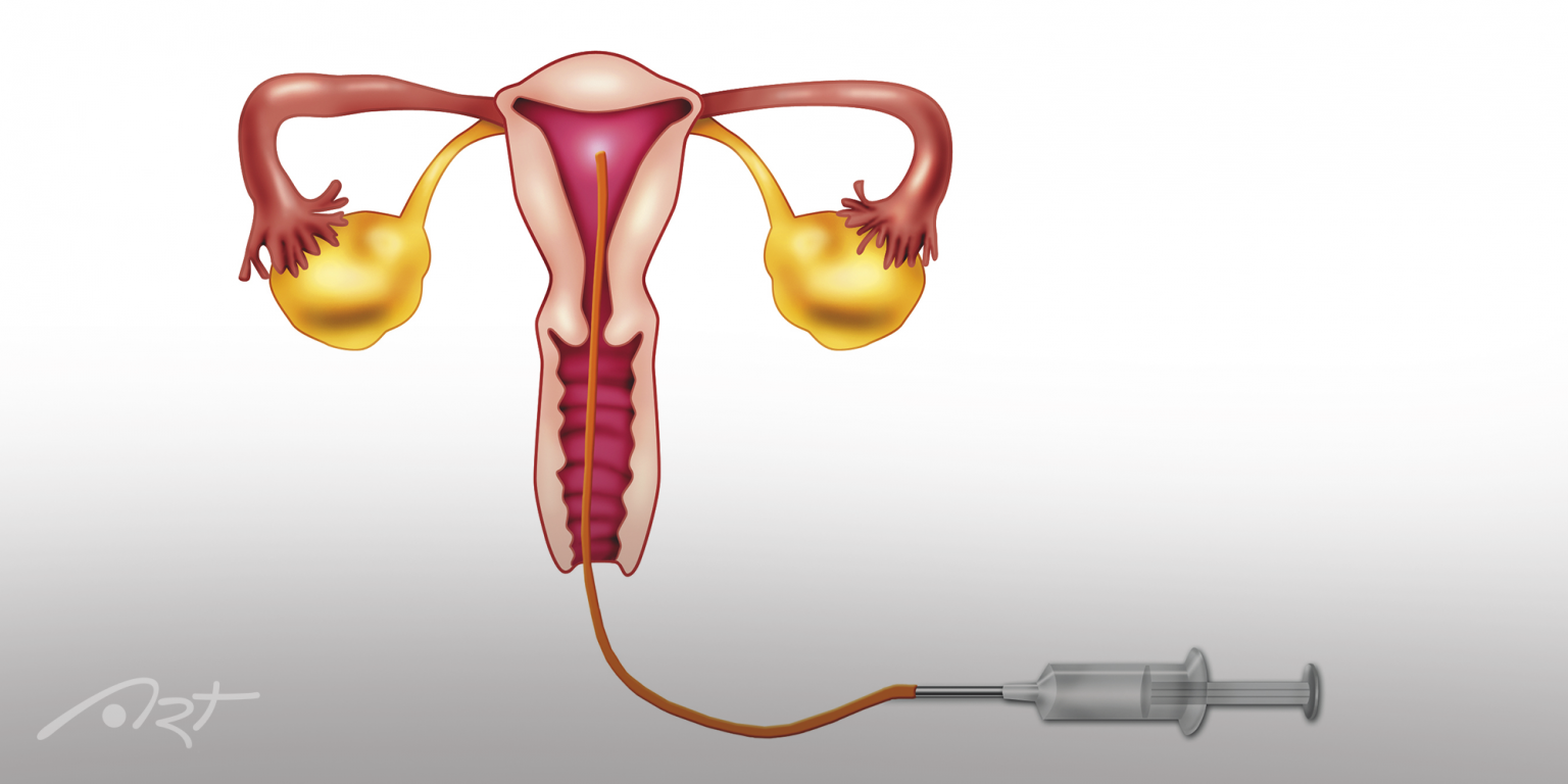 Inseminação Artificial Indicações Da Técnica Art Medicina Reprodutiva