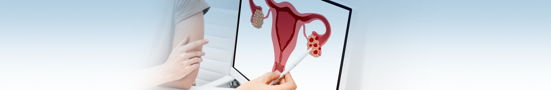 Endometriomas: conheça os sintomas