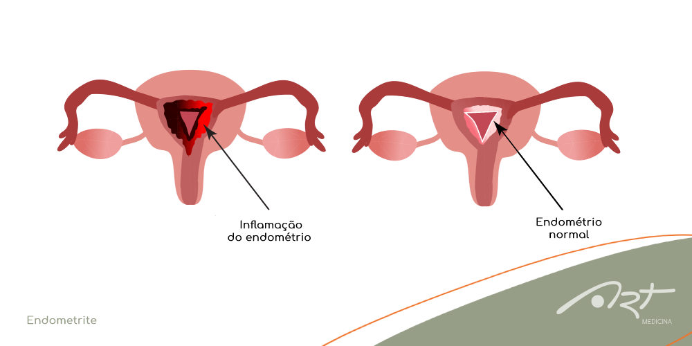 Endometrite: como é feito o tratamento