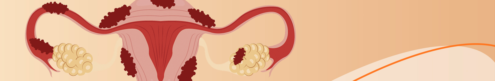 Endometriose profunda: veja os sintomas