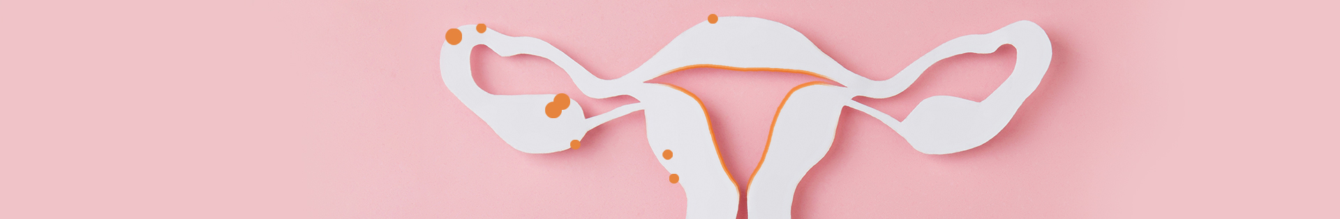 Endométrio e endometriose: qual é a relação?