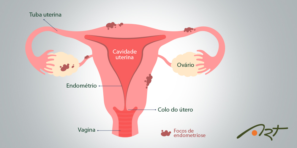 Menstruação retrógrada: saiba o que é e qual doença ela pode causar